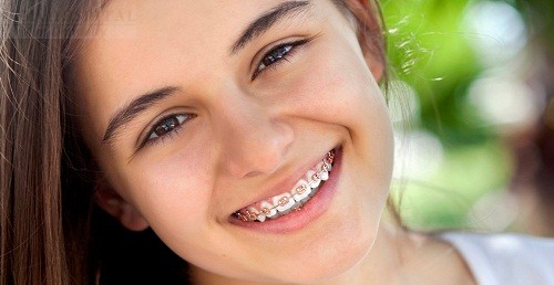 Phương Pháp Vệ Sinh Răng Miệng Sau Khi Niềng Răng