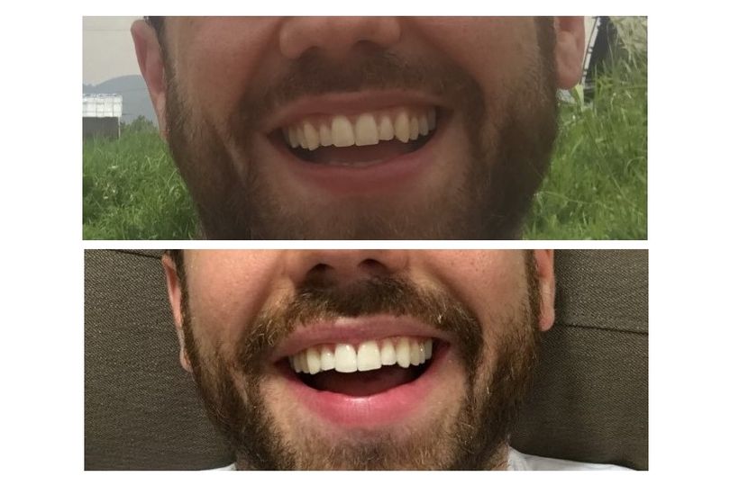 Review chỉnh nha Invisalign (máng năng trong suốt): Sở hữu nụ cười rạng rỡ mà không cần đeo mắc cài kim loại