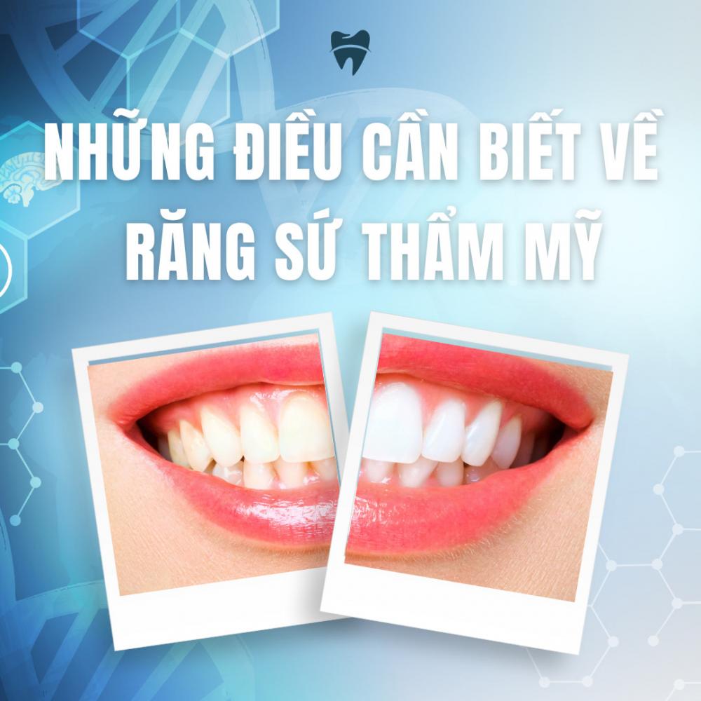 Răng sứ thẩm mỹ là gì